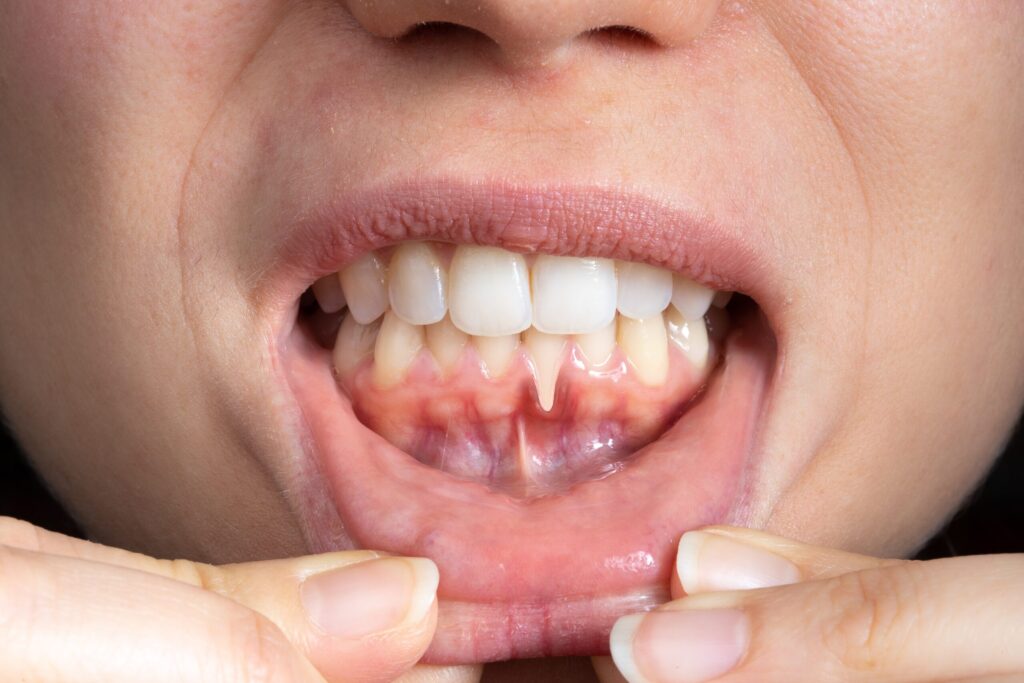 Preparing for teeth whitening with receding gums Chesham